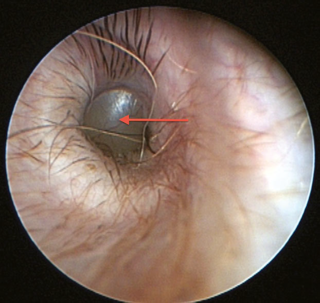 Otoscopic image of tympanic membrane of CKCS