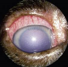 Glaucoma eye