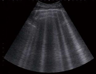 LUS B-lines from cardiogenic pulmonary edema