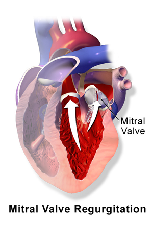 Mitral Regurgitation