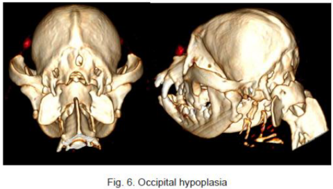 Figure 6 -- Occipital Hypoplasia
