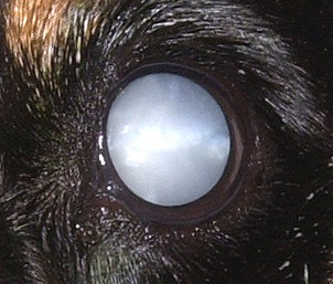 Cataract