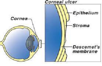 Corneal Ulcer Diagram