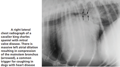 Cardiac Cough Cause