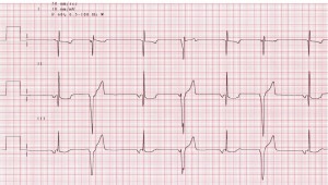 Electrocardiogram