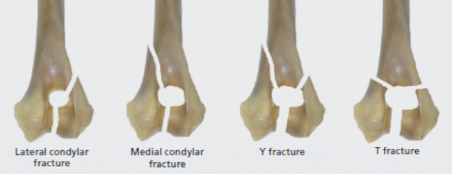 Classification of humeral condylar fractures