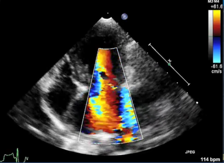 Haggstrom Color Doppler of Mitral Regurgitation