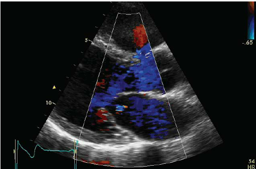 M-Mode Echocardiogram