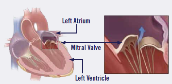 Mitral Valve Leakage