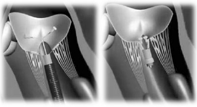 Mitral Valve Clamp - Orton