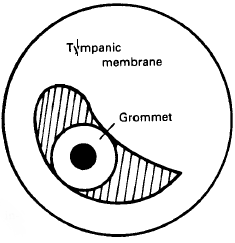 Grommet in ear drum