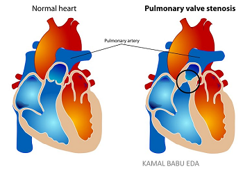 Pulmonic Stenosis