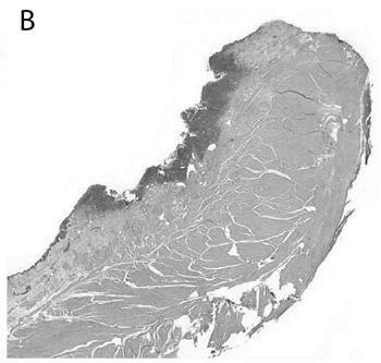 urethral urothelial carcinoma