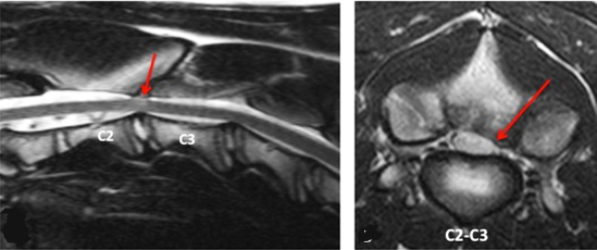 Wobbler's Syndrome